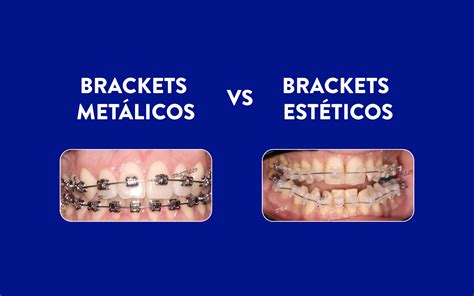 brackets metalicos esteticos y de porcelana|Diferencia entre brackets metálicos, estéticos o linguales.